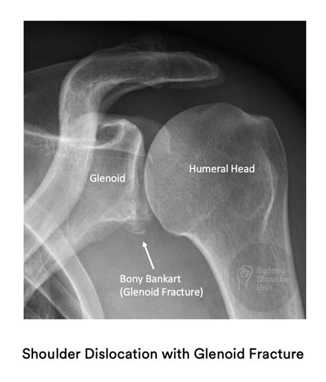 shoulder labrum tear x ray